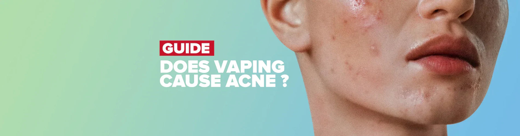 Does Vaping Cause Acne? The Comprehensive Guide